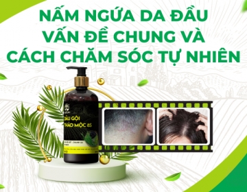 ITCH SCALP FUNGUS AND NATURAL CARE